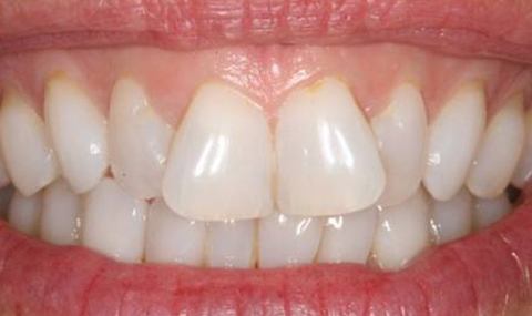Oversized front teeth before cosmetic dentistry
