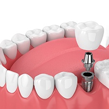 Illustration of a single dental implant in Richmond, VA