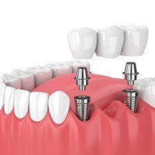 dental bridge being placed onto two dental implant posts