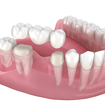 Illustration of traditional dental bridge in Richmond, VA