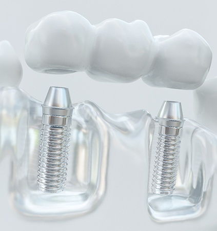 Illustration of implant dental bridge in Richmond, VA on plastic model