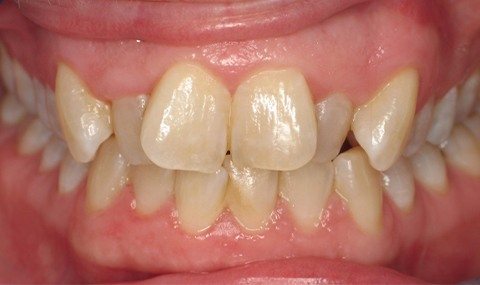 Improperly aligned smile before Invisalign