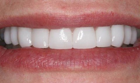 Perfected smile after porcelain veneers