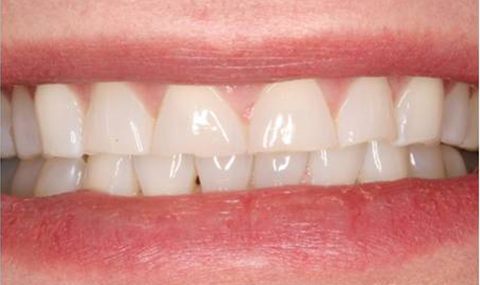 Worn smile before porcelain veneers