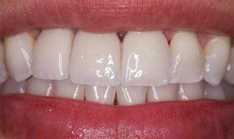 Smile perfected with dental implant supported replacement teeth