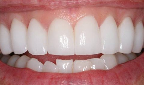 Flawless smile after cosmetic dentistry