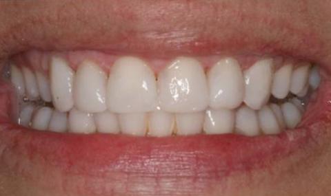 Healthy beautiful smile after cosmetic dentistry