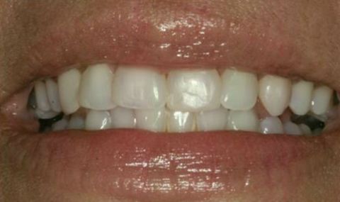 Discolored smile before cosmetic dentistry