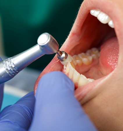Closeup of dental assistant polishing patient's teeth