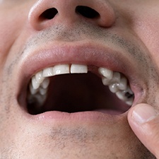 man pointing to missing tooth 