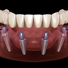 Implant dentures in Richmond 