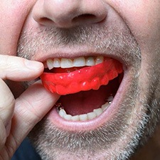 a mouthguard to prevent dental emergencies in Richmond