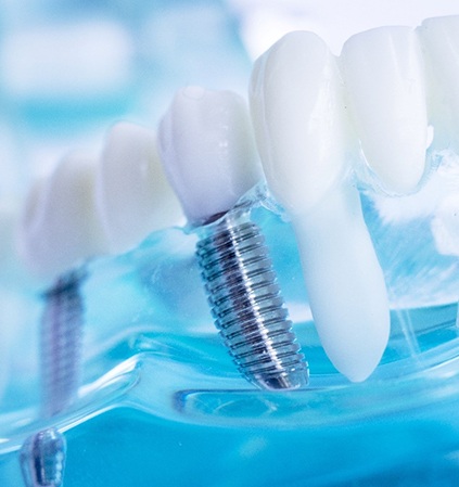 Closeup of model dental implants