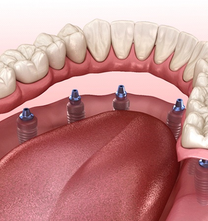 Diagram showing how implant dentures in Patterson work