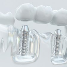 Close-up of a model of a dental bridge and dental implants in Richmond, VA
