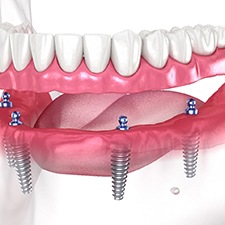 Illustration of dentures and four dental implants in Richmond, VA