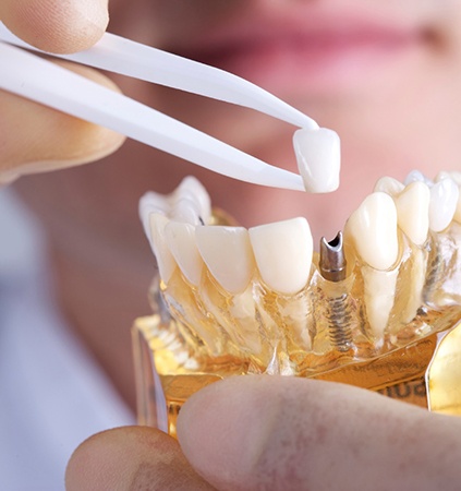 Model smile with natural teeth and implant supported replacement tooth
