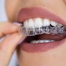 Patient putting clear aligner on top teeth