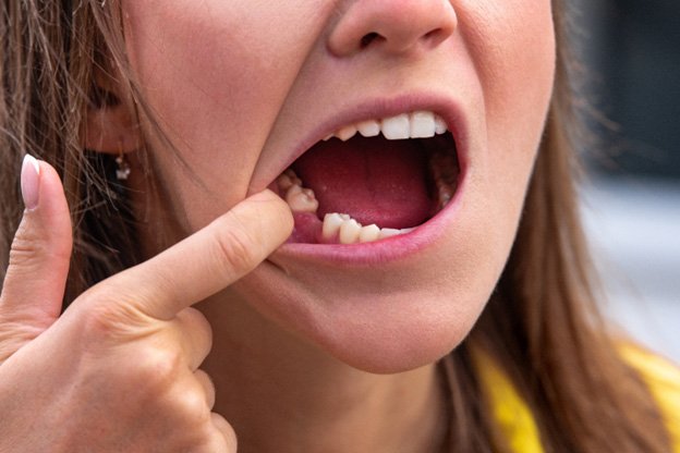 Patient in Tuckahoe pulling cheek to show missing tooth