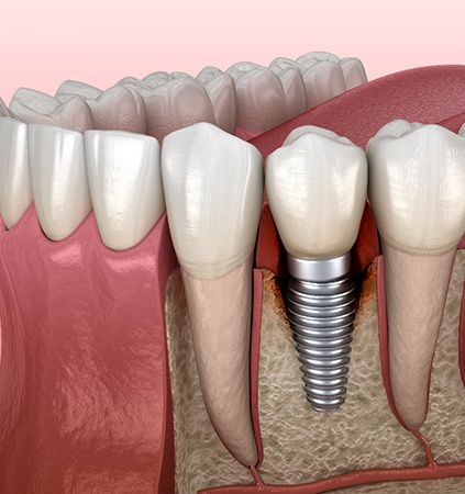 Illustration of a failed dental implant in Richmond, VA