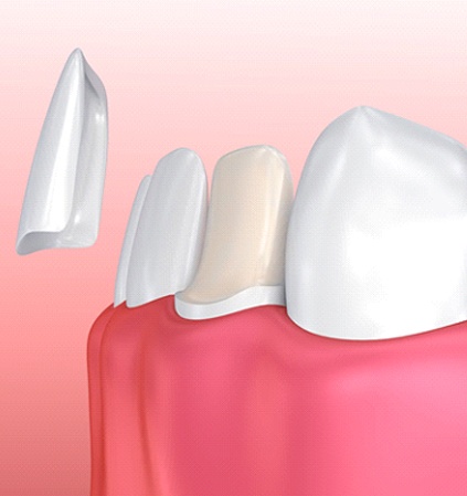 diagram of veneers being placed on tooth