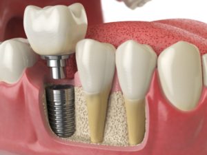 anatomy of healthy teeth and dental implant illustration