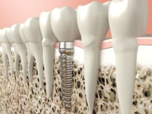 Model of dental implant in jawbone