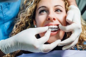 Woman getting clear aligners fitted over her teeth by dentist. 